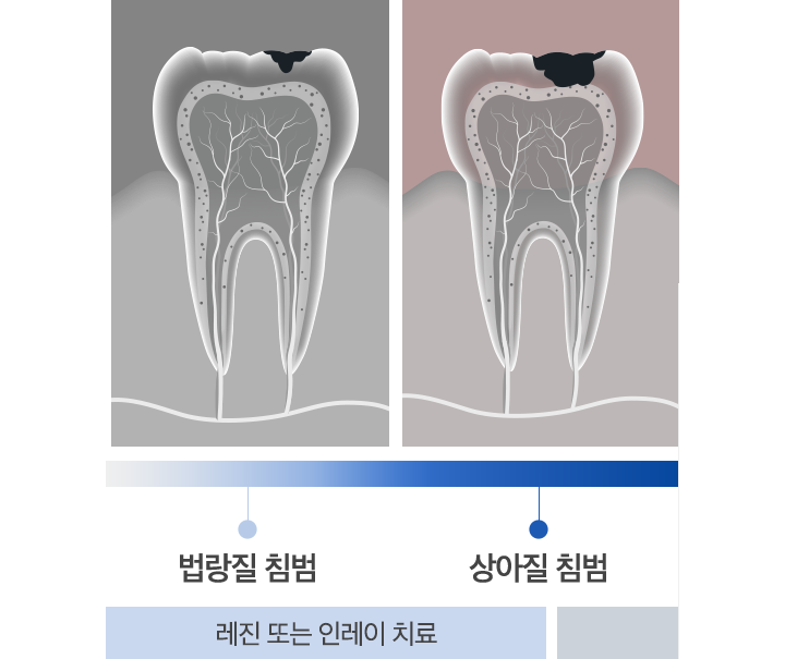 법랑질 침범, 상아질 침범