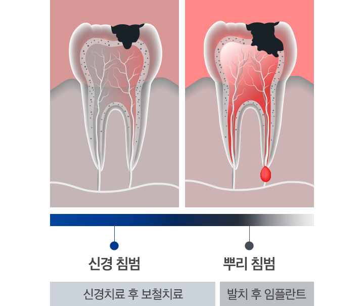 신경 침범, 뿌리 침범