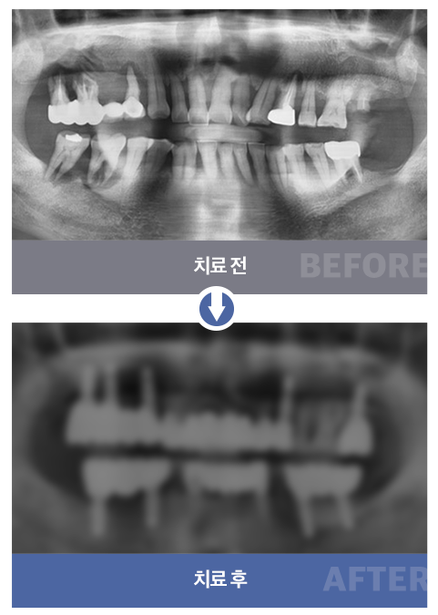 임플란트