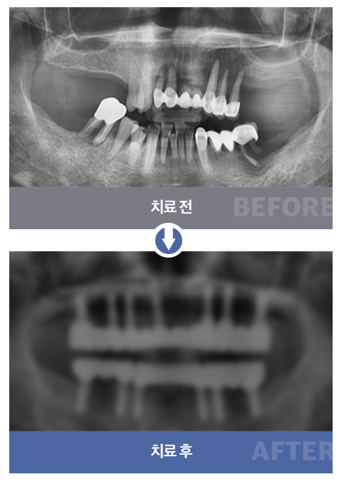 네비게이션 임플란트