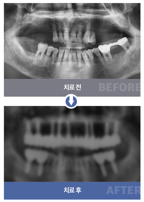 임플란트 결합 틀니