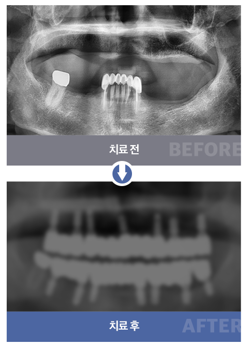 완전 틀니