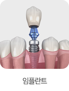 임플란트