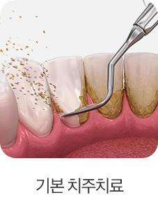 기본 치주치료