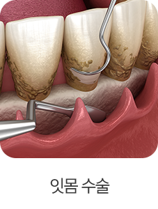 잇몸 수술