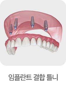 임플란트 결합 틀니